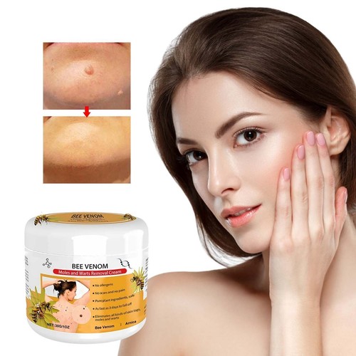 Bee venom wart - wart, remover